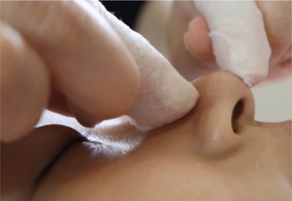 毛穴エクストラクション - 東京のグリーンピールコンテスト受賞サロン