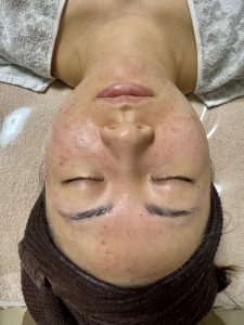 グリーンピール東京　グリーンピールニキビ　ニキビ　greenpeel greenpeel-tokyo greenpeel-acne